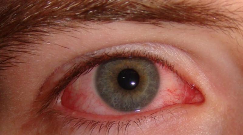 Savjet 1: Kako se riješiti crnog oka u jednom danu